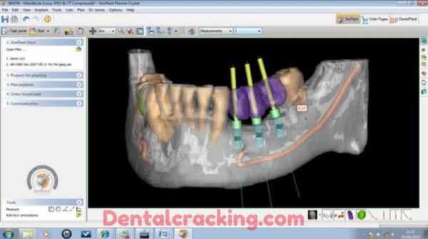 Simplant crack