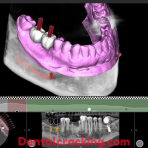 Implant 3D