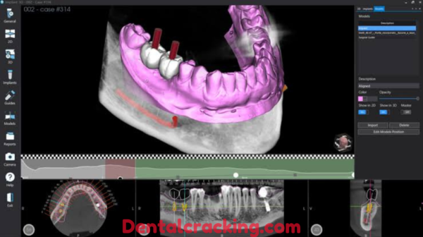 Implant 3D