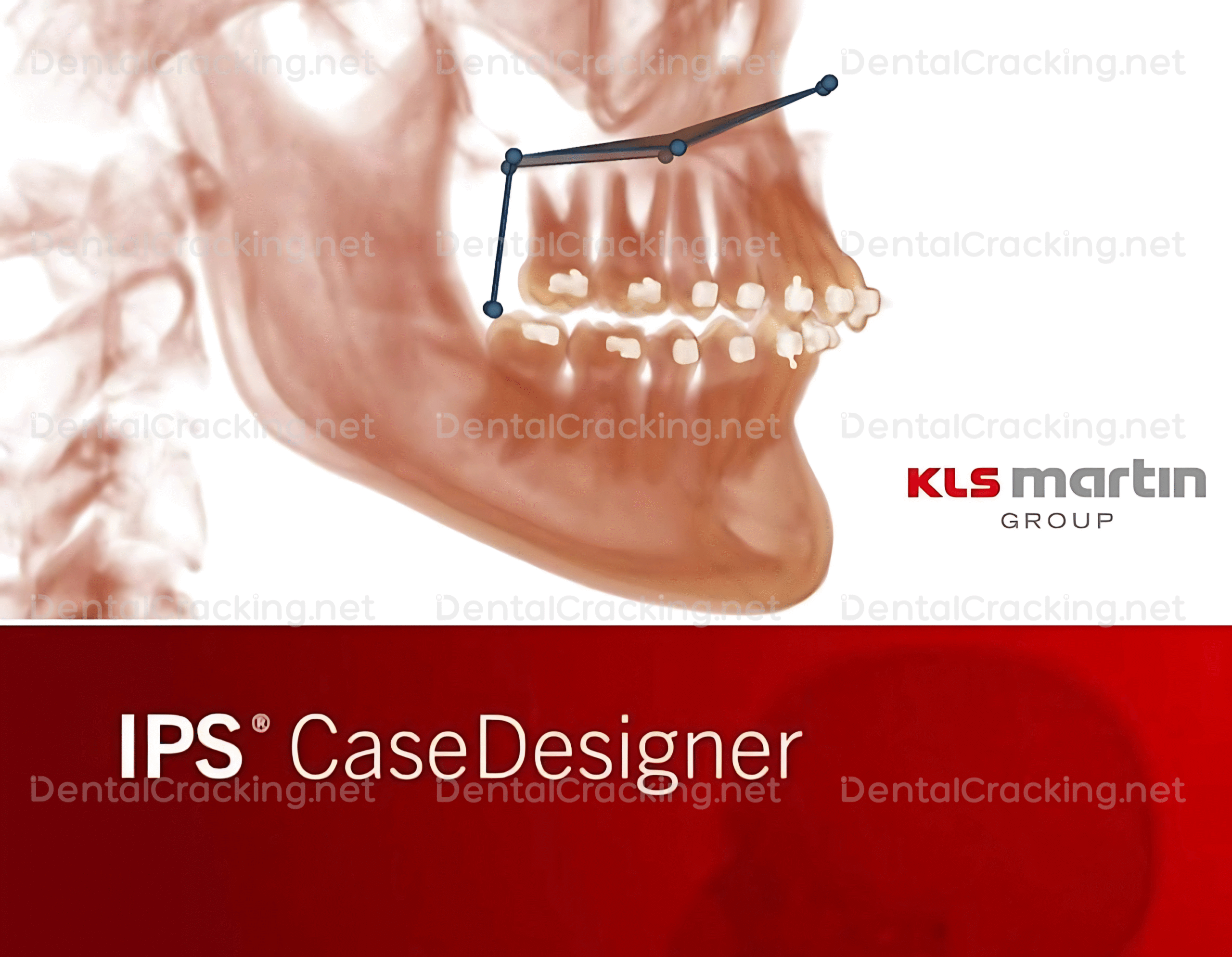 ips case designer